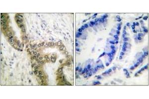 Immunohistochemistry analysis of paraffin-embedded human lung carcinoma tissue, using p53 (Acetyl-Lys386) Antibody. (p53 抗体  (acLys386))