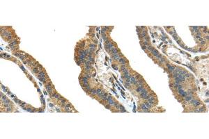 Immunohistochemistry of paraffin-embedded Human thyroid cancer tissue using TMPRSS13 Polyclonal Antibody at dilution 1:40 (TMPRSS13 抗体)