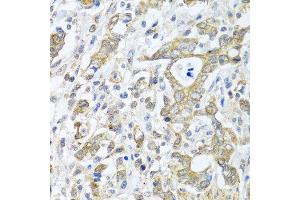Immunohistochemistry of paraffin-embedded human gastric cancer using TICAM1 antibody at dilution of 1:100 (40x lens). (TICAM1 抗体)