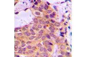 Immunohistochemical analysis of PKC zeta staining in human breast cancer formalin fixed paraffin embedded tissue section. (PKC zeta 抗体  (C-Term))