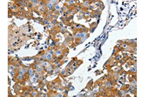 The image on the left is immunohistochemistry of paraffin-embedded Human breast cancer tissue using ABIN7190498(DPYSL5 Antibody) at dilution 1/10, on the right is treated with synthetic peptide. (DPYSL5 抗体)