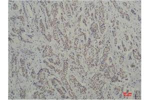 Immunohistochemistry (IHC) analysis of paraffin-embedded Human Breast Carcinoma using TBP/TATA Binding Protein Mouse Monoclonal Antibody diluted at 1:200. (TBP 抗体)
