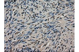 Immunohistochemical staining of paraffin-embedded Adenocarcinoma of colon tissue using anti-LDHAmouse monoclonal antibody. (Lactate Dehydrogenase A 抗体)