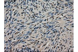 Immunohistochemical staining of paraffin-embedded Adenocarcinoma of colon tissue using anti-LDHAmouse monoclonal antibody. (Lactate Dehydrogenase A 抗体)
