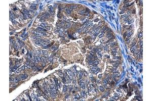 IHC-P Image CaMKK beta antibody detects CaMKK beta protein at cytoplasm in human endometrial cancer by immunohistochemical analysis.
