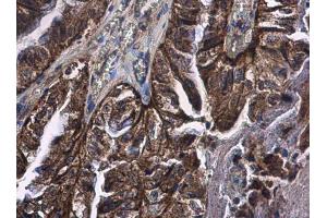 IHC-P Image CD89 antibody detects CD89 protein at cytoplasm in human cervical carcinoma by immunohistochemical analysis. (FCAR 抗体)