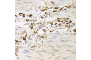 Immunohistochemistry of paraffin-embedded human gastric cancer using LSP1 Antibody. (LSP1 抗体)