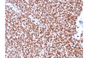 Formalin-fixed, paraffin-embedded human Ewing's Sarcoma stained with NKX2. (Recombinant Nkx2-2 抗体)