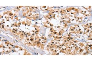 Immunohistochemistry of paraffin-embedded Human thyroid cancer tissue using NCAPD3 Polyclonal Antibody at dilution 1:50 (NCAPD3 抗体)
