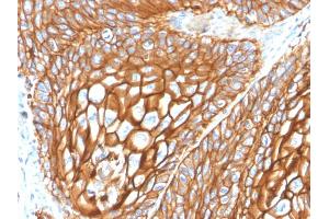 Formalin-fixed, paraffin-embedded human Basal Cell Carcinoma stained with CD9 Mouse Monoclonal Antibody (CD9/2343). (CD9 抗体)