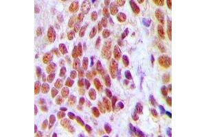 Immunohistochemical analysis of HMGB2 staining in human breast cancer formalin fixed paraffin embedded tissue section.