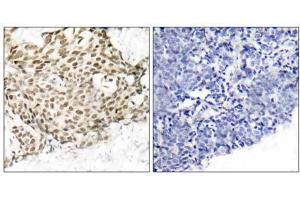 Immunohistochemical analysis of paraffin-embedded human breast carcinoma tissue using p95/NBS1 (Ab-343) antibody (E021058). (Nibrin 抗体)