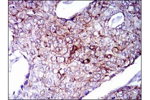 Immunohistochemical analysis of paraffin-embedded breast cancer tissues using CK5 mouse mAb with DAB staining. (Cytokeratin 5 抗体)