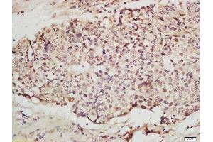 Formalin-fixed and paraffin embedded human layngocarcinoma labeled with Anti-IRF2 Polyclonal Antibody, Unconjugated  at 1:200 followed by conjugation to the secondary antibody and DAB staining. (IRF2 抗体  (AA 81-180))