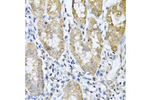 Immunohistochemistry of paraffin-embedded human gastric cancer using ASIP antibody (ABIN5974140) at dilution of 1/100 (40x lens). (ASIP 抗体)