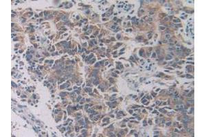 IHC-P analysis of Human Prostate Gland Cancer Tissue, with DAB staining. (SLC12A3 抗体  (AA 867-1024))