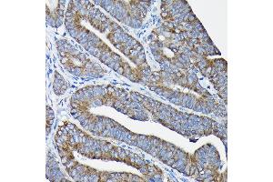 Immunohistochemistry of paraffin-embedded human colon carcinoma using Nesprin 1 Rabbit pAb (ABIN7270520) at dilution of 1:100 (40x lens). (SYNE1 抗体)