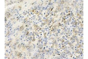 ABIN6259327 and ABIN6275300 at 1/100 staining human melanoma by IHC-P. (NBPF5 抗体)