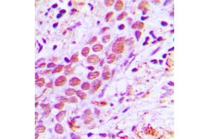 Immunohistochemical analysis of USF2 staining in human breast cancer formalin fixed paraffin embedded tissue section. (USF2 抗体  (Center))
