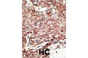 Formalin-fixed and paraffin-embedded human hepatocellular carcinoma tissue reacted with the primary antibody, which was peroxidase-conjugated to the secondary antibody, followed by AEC staining. (PRMT7 抗体  (N-Term))