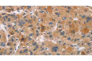 Immunohistochemistry of paraffin-embedded Human liver cancer using CYP4A11 Polyclonal Antibody at dilution of 1:30 (CYP4A11 抗体)