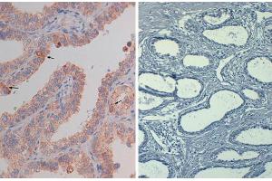 Immunohistochemistry of mouse Anti-AKT pS473 (MOUSE) Biotin Conjugated  at 40X Tissue: prostate Fixation: FFPE buffered formalin 10% conc Antigen retrieval: Heat, Citrate pH 6. (AKT1 抗体  (Internal Region, pSer473) (Biotin))