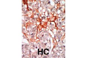 Formalin-fixed and paraffin-embedded human hepatocellular carcinoma tissue reacted with MATK polyclonal antibody  , which was peroxidase-conjugated to the secondary antibody, followed by DAB staining. (MATK 抗体  (N-Term))