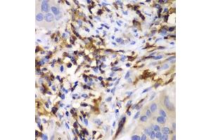 Immunohistochemistry of paraffin-embedded human liver cancer using HCLS1 antibody (ABIN3023093, ABIN3023094, ABIN3023095 and ABIN6219386) at dilution of 1:100 (40x lens). (HCLS1 抗体  (AA 1-280))