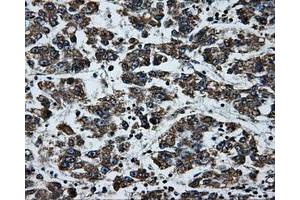Immunohistochemical staining of paraffin-embedded Carcinoma of liver tissue using anti-BRAFmouse monoclonal antibody. (BRAF 抗体)