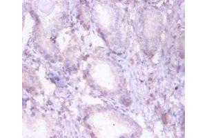 Immunohistochemistry of paraffin-embedded human prostate tissue using ABIN7173377 at dilution of 1:50 (HADHB 抗体  (AA 35-283))