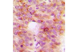 Immunohistochemical analysis of TANK staining in human breast cancer formalin fixed paraffin embedded tissue section. (TANK 抗体  (Center))