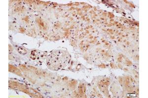 Formalin-fixed and paraffin embedded human gastric carcinoma labeled with Rabbit Anti Phospho-MEF2A (Thr312) Polyclonal Antibody, Unconjugated (ABIN743768) at 1:200 followed by conjugation to the secondary antibody and DAB staining (MEF2A 抗体  (pThr312))