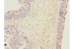 Immunohistochemistry of paraffin-embedded human ovarian cancer using ABIN7150502 at dilution of 1:100 (DNAJB1 抗体  (AA 1-340))