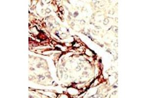 Formalin-fixed and paraffin-embedded human cancer tissue (breast carcinoma) reacted with the primary antibody, which was peroxidase-conjugated to the secondary antibody, followed by DAB staining. (LKB1 抗体  (N-Term))