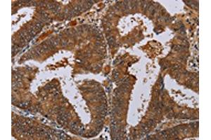 The image on the left is immunohistochemistry of paraffin-embedded Human colon cancer tissue using ABIN7130067(LCMT1 Antibody) at dilution 1/20, on the right is treated with fusion protein. (LCMT1 抗体)