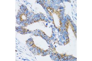 Immunohistochemistry of paraffin-embedded human colon carcinoma using SIAH1 antibody (ABIN5971329) at dilution of 1/100 (40x lens). (SIAH1 抗体)