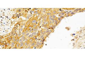 Immunohistochemistry of paraffin-embedded Human esophageal cancer using PRKCE Polyclonal Antibody at dilution of 1:200 (40x lens). (PKC epsilon 抗体)