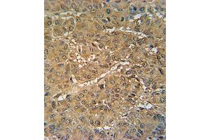 VKORC1 Antibody (N-term) (ABIN652040 and ABIN2840514) immunohistochemistry analysis in formalin fixed and paraffin embedded human hepatocarcinoma followed by peroxidase conjugation of the secondary antibody and DAB staining. (VKORC1 抗体  (N-Term))