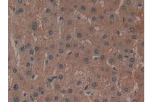 Detection of ADCY3 in Human Liver cancer Tissue using Polyclonal Antibody to Adenylate Cyclase 3 (ADCY3) (ADCY3 抗体  (AA 501-736))