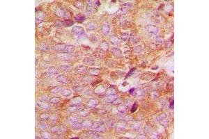 Immunohistochemical analysis of MKK6 staining in human breast cancer formalin fixed paraffin embedded tissue section. (MAP2K6 抗体  (N-Term))