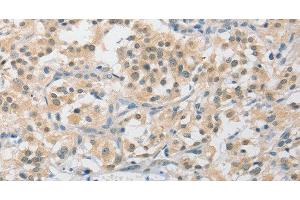 Immunohistochemistry of paraffin-embedded Human thyroid cancer tissue using APLF Polyclonal Antibody at dilution 1:40 (APLF 抗体)