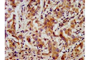 IHC image of ABIN7144009 diluted at 1:200 and staining in paraffin-embedded human liver cancer performed on a Leica BondTM system. (AMMECR1 抗体  (AA 146-248))