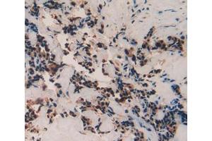 Used in DAB staining on fromalin fixed paraffin- embedded breast cancer tissue