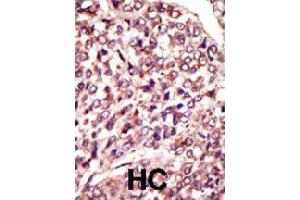 Formalin-fixed and paraffin-embedded human hepatocellular carcinoma tissue reacted with MGAT1 polyclonal antibody  , which was peroxidase-conjugated to the secondary antibody, followed by AEC staining . (MGAT1 抗体  (C-Term))