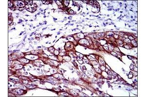 Immunohistochemical analysis of paraffin-embedded stomach cancer tissues using CK5 mouse mAb with DAB staining. (Cytokeratin 5 抗体)