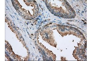 Immunohistochemical staining of paraffin-embedded Adenocarcinoma of ovary tissue using anti-ALDH3A1 mouse monoclonal antibody.