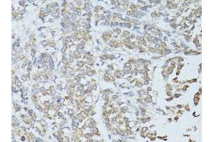 Immunohistochemistry of paraffin-embedded human colon carcinoma using TEFM antibody.