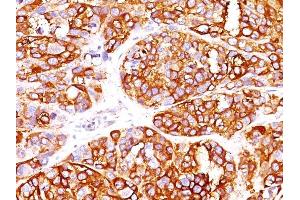 Formalin-fixed, paraffin-embedded human Melanoma stained with MART-1 Rabbit Recombinant Monoclonal Antibody (MLANA/1409R). (Recombinant MLANA 抗体)