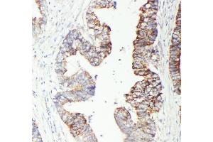 Anti-GST3/GST pi antibody, IHC(P) IHC(P): Human Intestinal Cancer Tissue (GSTP1 抗体  (N-Term))