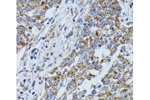 Immunohistochemistry of paraffin-embedded Human lung cancer using ATP5B Polyclonal Antibody at dilution of 1:100 (40x lens). (ATP5B 抗体)